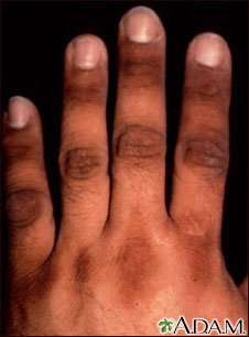 Acanthosis nigricans on the hand Acanthosis nigricans on the hand