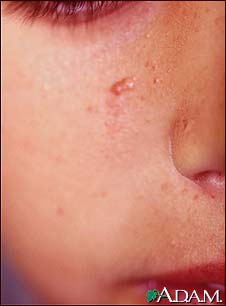 Tuberous sclerosis, angiofibromas  - face