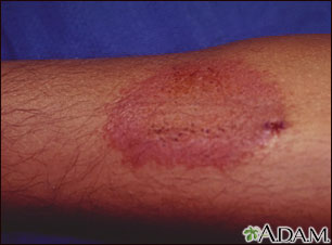 Dermatitis - contact Dermatitis - contact