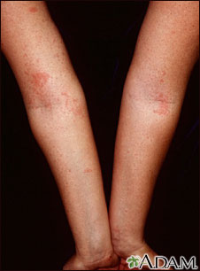 Dermatitis - atopic on the arms Dermatitis - atopic on the arms