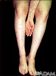 Dermatitis - herpetiformis on the arm and legs Dermatitis - herpetiformis on the arm and legs
