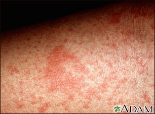 Eczema, atopic - close-up Eczema, atopic - close-up