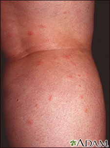 Insect bites on the legs