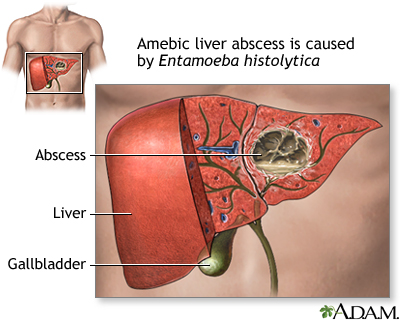 Amebic liver abscess Amebic liver abscess