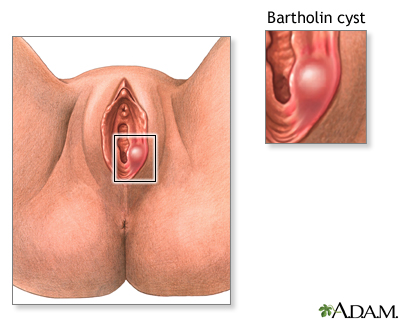 Bartholin cyst or abscess Bartholin cyst or abscess