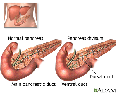 Pancreas divisum Pancreas divisum