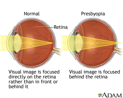 Presbyopia Presbyopia