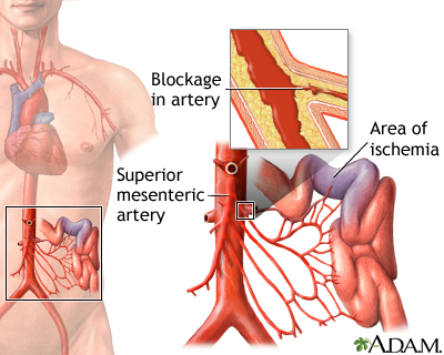 Mesenteric artery ischemia and infarction Mesenteric artery ischemia and infarction