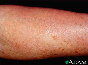 Mastocytosis - diffuse cutaneous