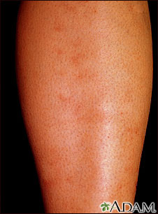 Polyarteritis - microscopic on the shin Polyarteritis - microscopic on the shin