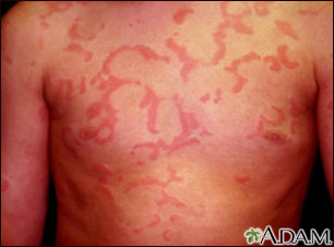 Hives (urticaria) on the chest Hives (urticaria) on the chest