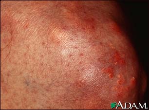 Xanthoma on the knee Xanthoma on the knee