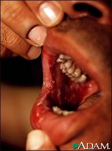 Pemphigus vulgaris - lesions in the mouth