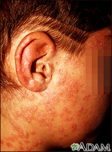 Psoriasis - guttate on the cheek Psoriasis - guttate on the cheek