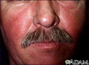 Systemic lupus erythematosus rash on the face Systemic lupus erythematosus rash on the face