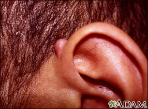 Keloid above the ear Keloid above the ear