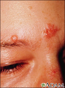 Sarcoidosis on the nose and forehead Sarcoidosis on the nose and forehead