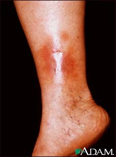 Dermatitis - stasis on the leg