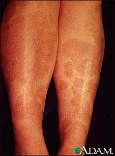 Granuloma annulare on the legs