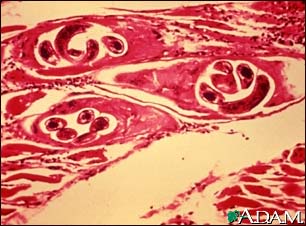 Trichinella spiralis in human muscle Trichinella spiralis in human muscle