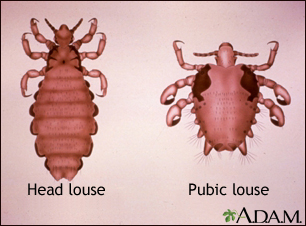 Head louse and pubic louse Head louse and pubic louse