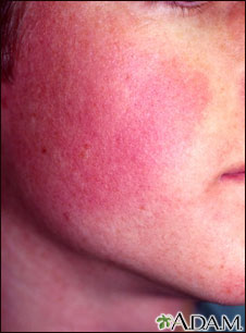 Keratosis pilaris rubra faceii Keratosis pilaris rubra faceii