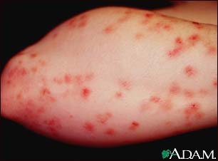 Dermatitis herpetiformis on the forearm