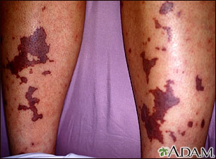 Meningococcemia on the calves Meningococcemia on the calves