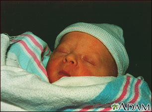 Jaundiced infant Jaundiced infant