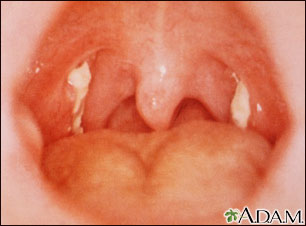Mononucleosis - view of the throat Mononucleosis - view of the throat