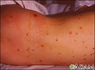 Meningococcal lesions on the back Meningococcal lesions on the back