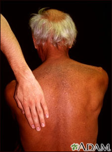 Hyperpigmentation w/malignancy Hyperpigmentation w/malignancy