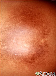 Post-inflammatory hyperpigmentation 2 Post-inflammatory hyperpigmentation 2
