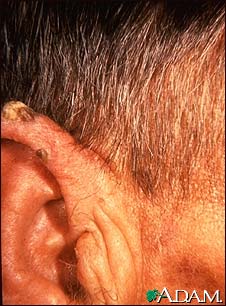 Actinic keratosis - ear Actinic keratosis - ear
