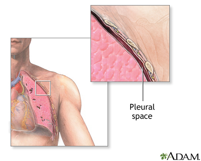 Chest tube insertion - series - Pleural cavity Chest tube insertion - series - Pleural cavity