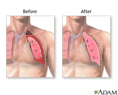 Before and after chest tube insertion