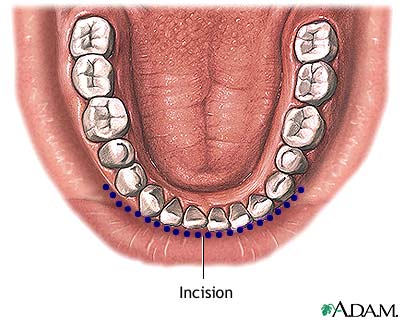 Incision