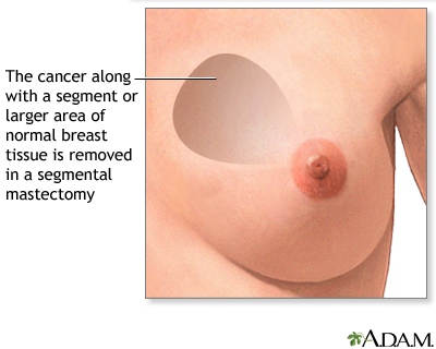 Mastectomy - Procedure part 1 Mastectomy - Procedure part 1
