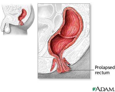 Indications Indications