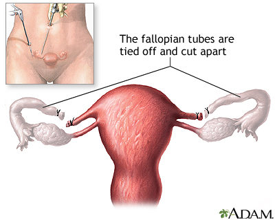 Tubal ligation