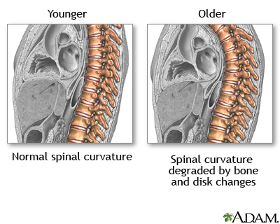 Changes in spine with age Changes in spine with age