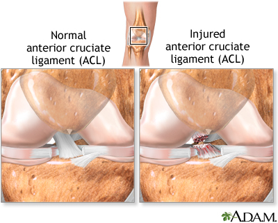 Anterior cruciate ligament (ACL) injury