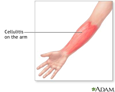 Cellulitis on the arm Cellulitis on the arm