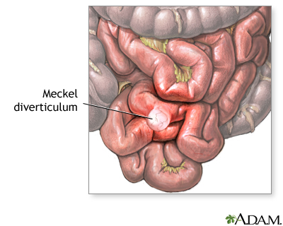 Meckel diverticulum Meckel diverticulum