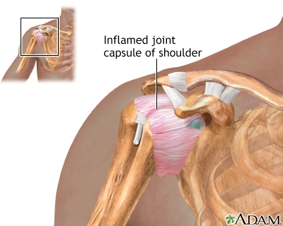 Shoulder joint inflammation Shoulder joint inflammation