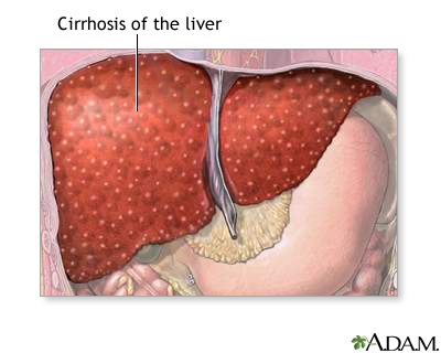 Cirrhosis of the liver Cirrhosis of the liver