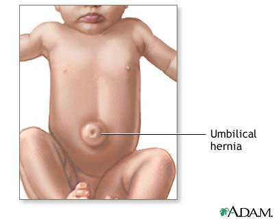Umbilical hernia Umbilical hernia