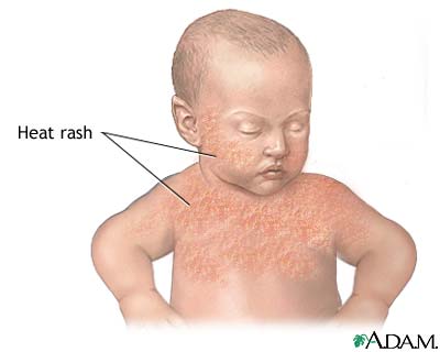 Infant heat rash Infant heat rash