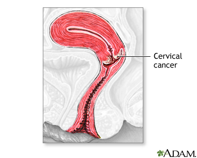 Cervical cancer Cervical cancer