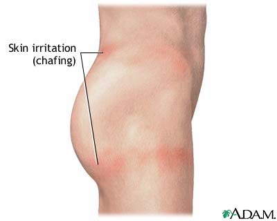 Chafing of the skin